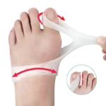 Orthèse hallux Valgus en Silicone, chevauchement des gros orteils